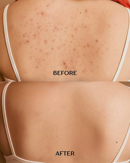 Glycolic Acid And Kojic Acid Body Wash For Dull & Acne-Prone Skin